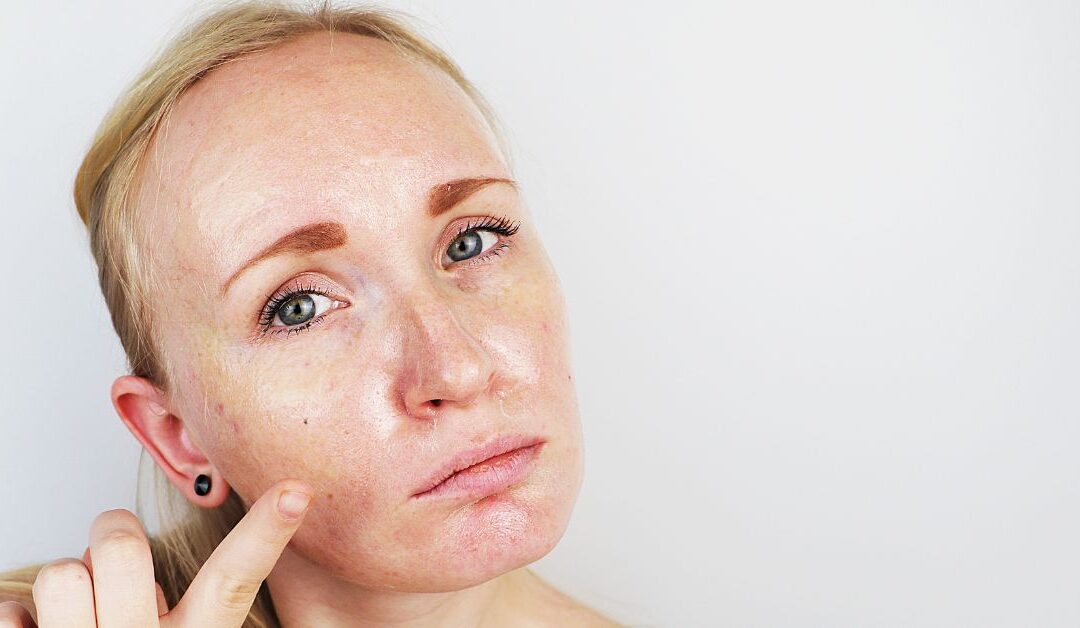 3 leggyakoribb bőrprobléma