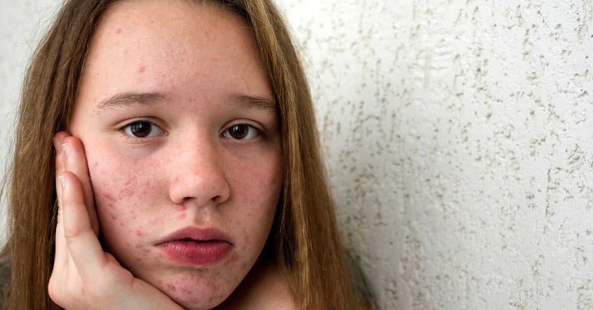 Akne, a pigmentáció, az aknés hegek, a tág és elzáródott pórusok, a melazma, a fény okozta öregedés és a ráncok?