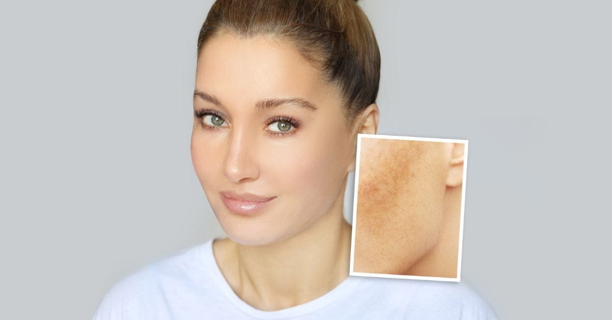 A májfoltok kezelése kozmetikai módszerekkel