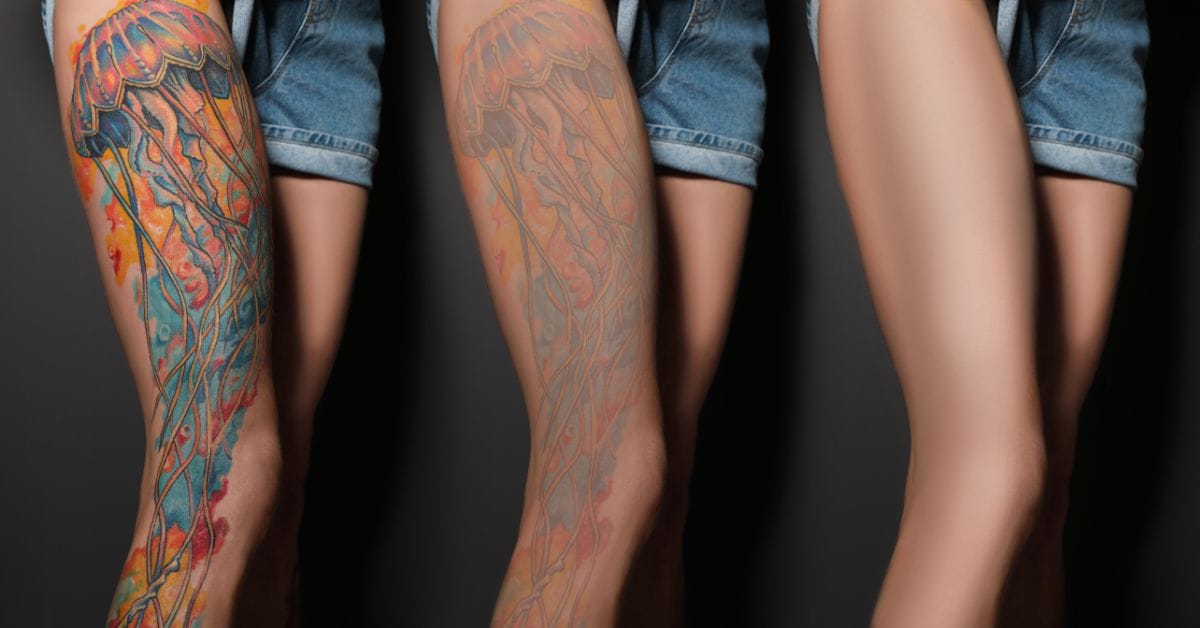 YAG Q-kapcsolt lézeres tetoválás eltávolítás az Ebony kozmetika és szépségszalonban