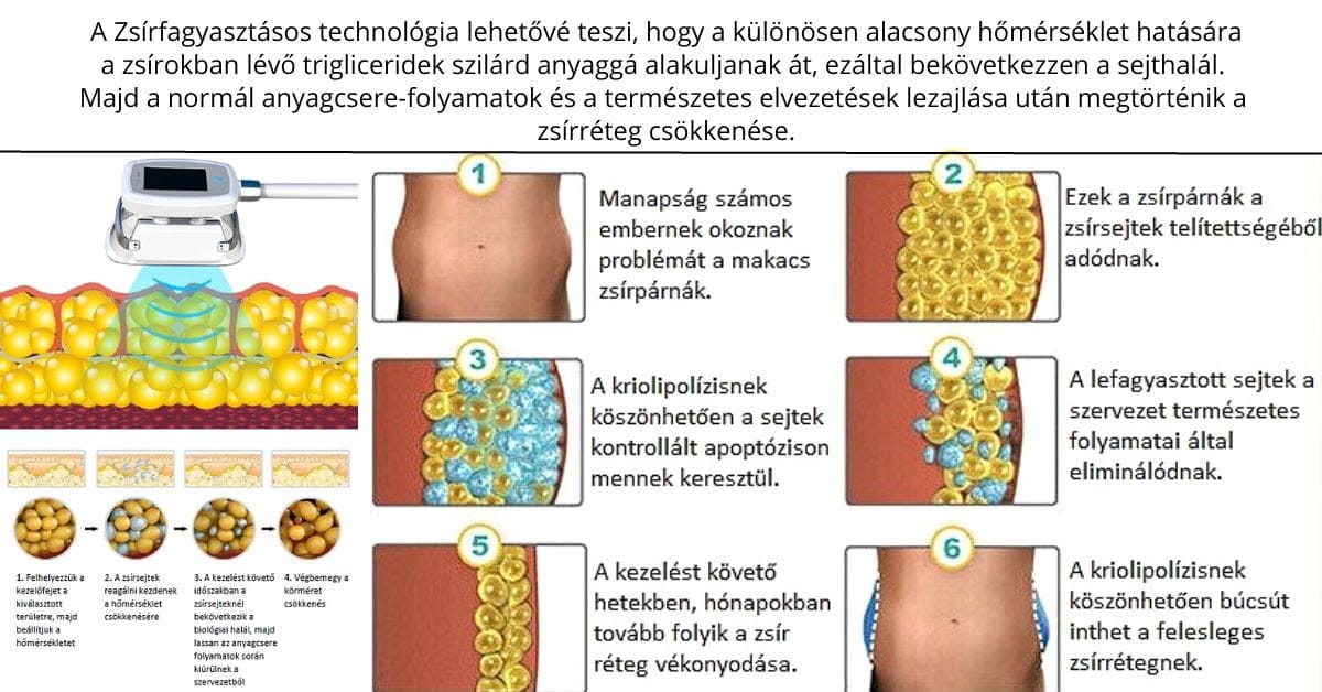 Zsírfagyasztás-Kriolipolízis-erdi-kozmetika2 Zsírfagyasztás Érden! A zsírfagyasztás technológia a megcélzott zsírsejtek lehűtésével bontja le a zsírsejteket