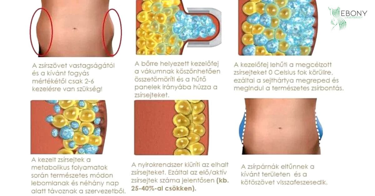 -10 fokon, 40 perc alatt akár 26%-os zsírcsökkenés fájdalom és vágás nélkül