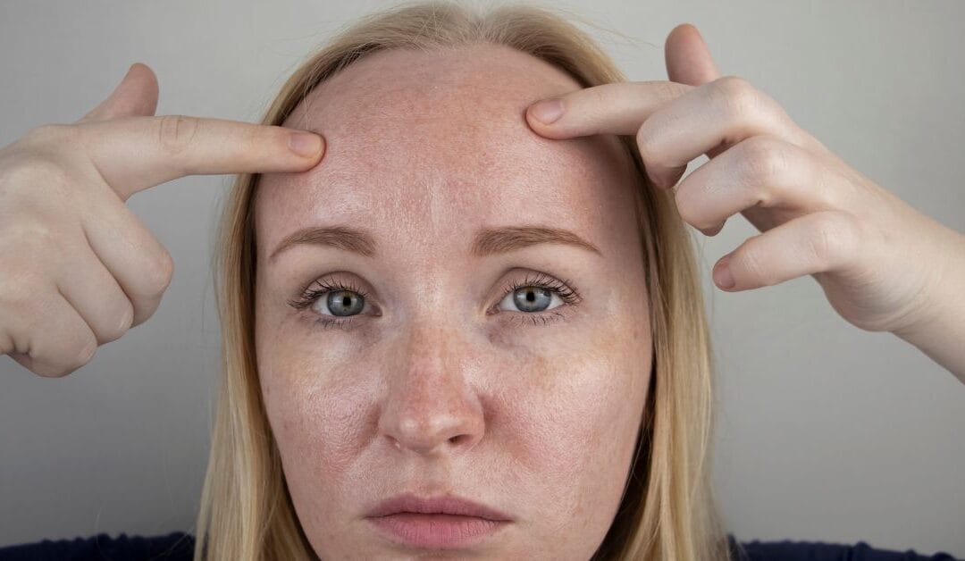 Zsíros, fénylő bőr? Íme a megoldás!