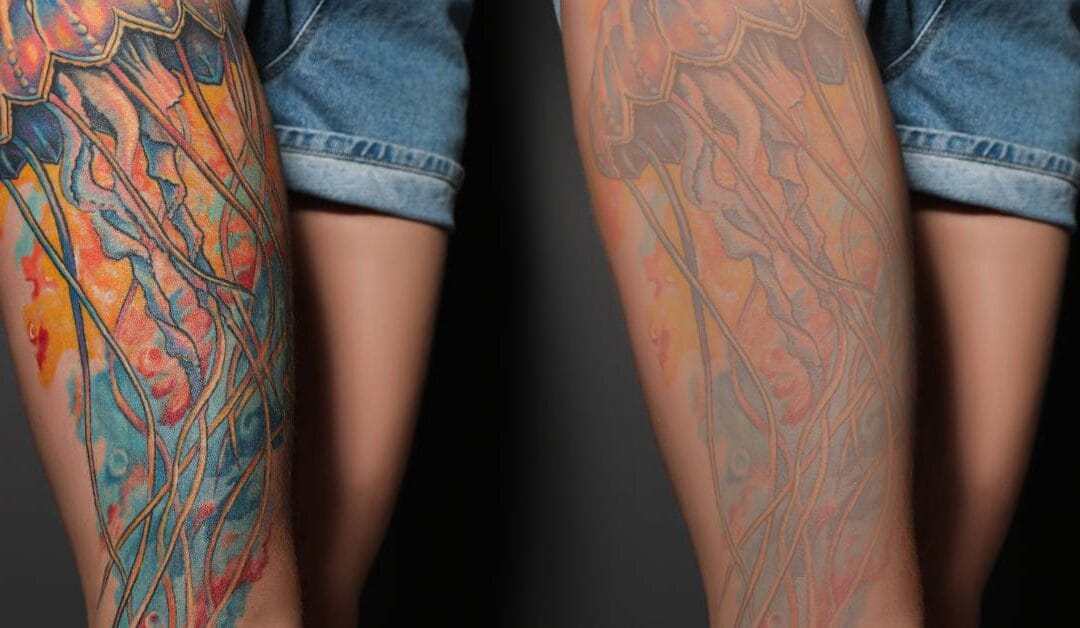 Lézeres tetoválás eltávolítás: a modern és hatékony megoldás