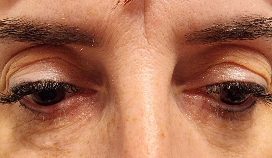 A szemhéj lógása és megereszkedése komoly problémát jelenthet