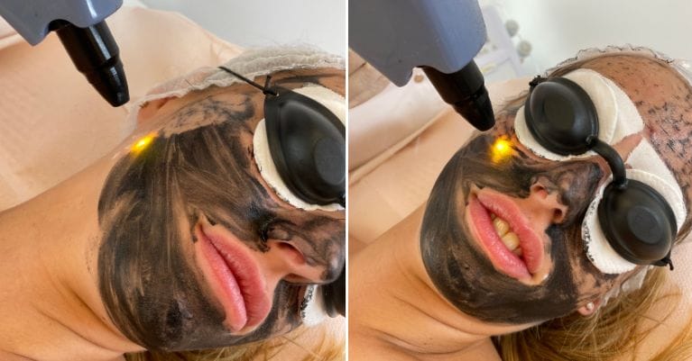 ND YAG Q-kapcsolt lézeres carbon peeling kezelés – Érd kozmetika ND YAG Q-kapcsolt lézeres carbon peeling kezelés – Érd kozmetika
