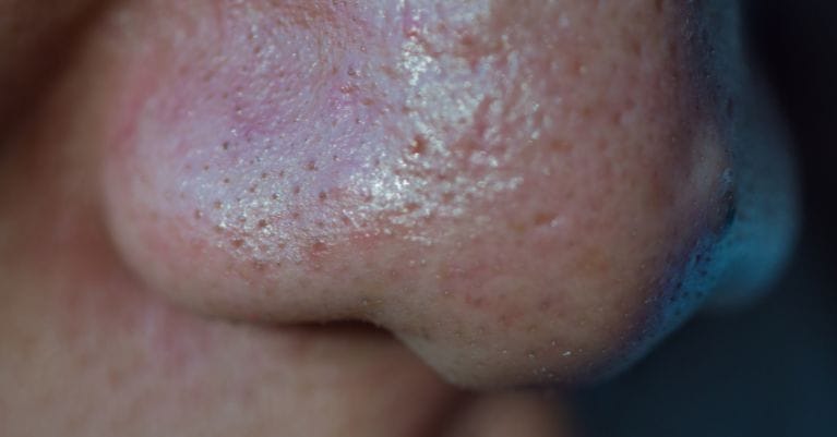 Tág pórusok és zsíros bőr: megértése és kezelése hatékonyan