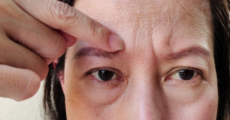 A ráncok kialakulásának okai és megelőzése