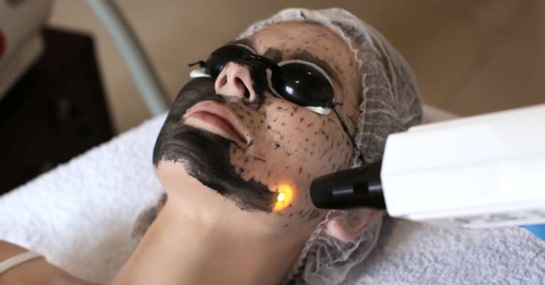 Tiszta, ragyogó bőr titka: Carbon peeling kezelés Érden