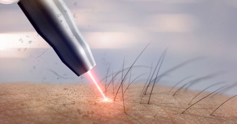 Lézeres szőrtelenítés