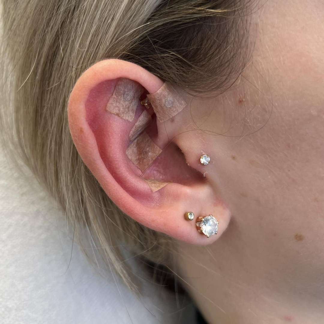 Fülakupunktúra-ÉRD (1) Fülakupunktúra-ÉRD