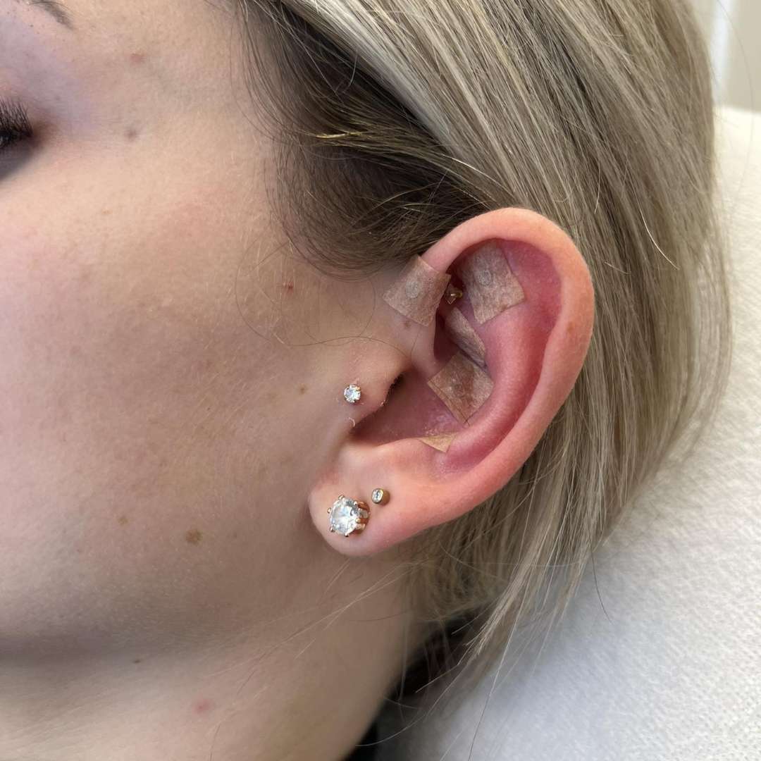 Fülakupunktúra-ÉRD Fülakupunktúra-ÉRD