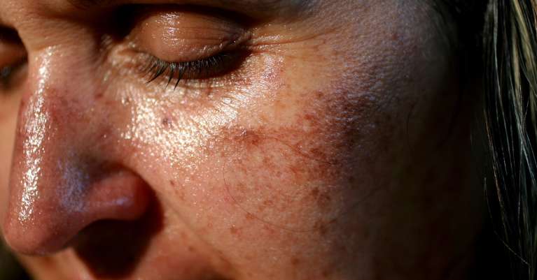 Mi okozhatja a pigmentfoltokat és a hiperpigmentációt?