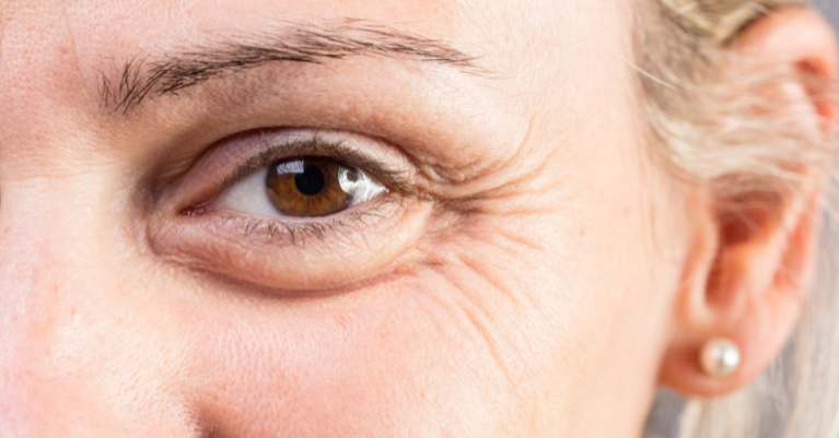 Hogyan csökkenti a Termikus Ionizáció a szem alatti ráncokat?