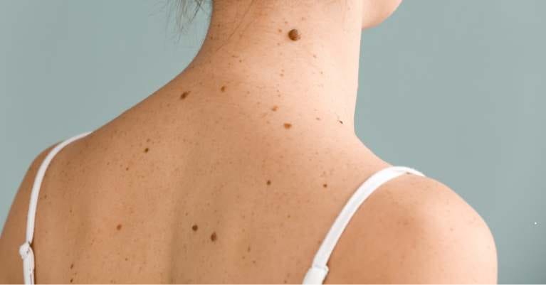 Mennyire veszélyesek a májfoltok és kik a leginkább érintettek?