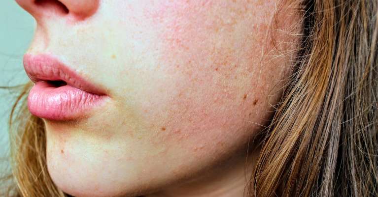 Bőrápolási tippek hidegebb évszakokra: Megelőzés és védelem