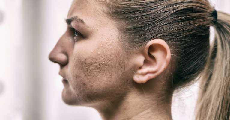 Aknés hegek eltüntetése: Frakcionált mikrotűs rádiófrekvencia