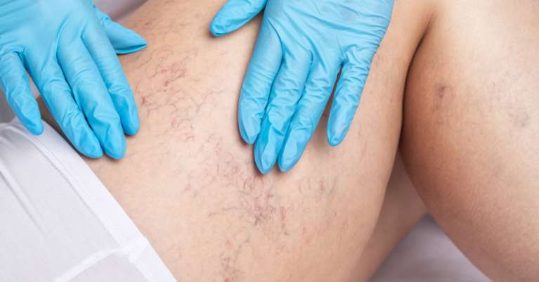 Értágulat kezelése: Hatékony módszerek és tippek