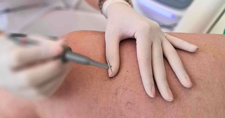 Thermokoaguláció – A Hatékony Megoldás Értágulatok Eltüntetésére Thermokoaguláció – A Hatékony Megoldás Értágulatok Eltüntetésére