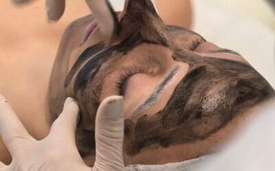5 érdekesség a lézeres Carbon Peelingről