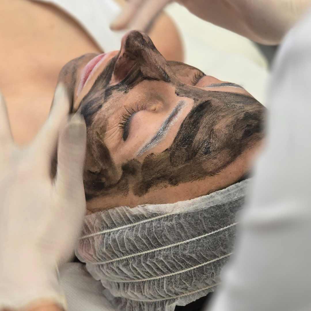 Carbon peeling kezelés Érden (1) Carbon peeling kezelés Érden