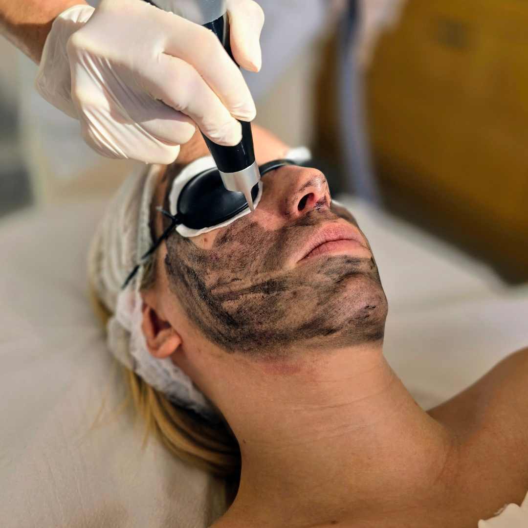 Carbon peeling kezelés Érden (2) Carbon peeling kezelés Érden