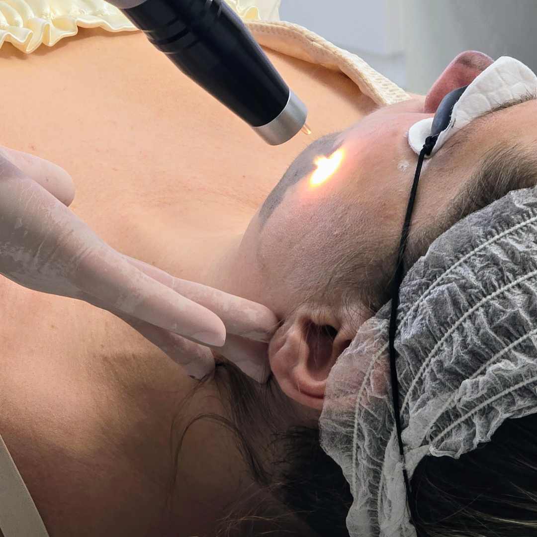 Carbon peeling kezelés Érden Carbon peeling kezelés Érden