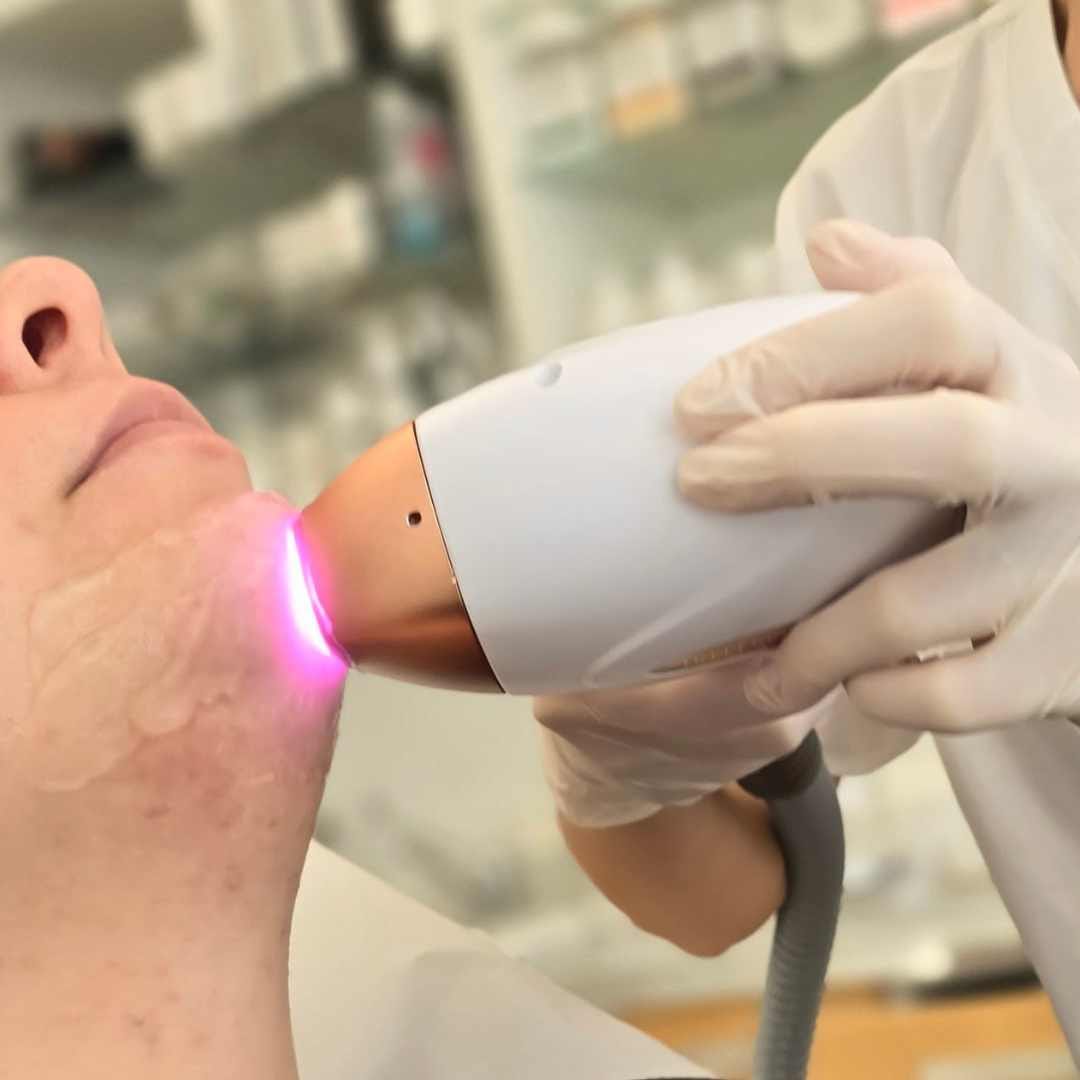 Dióda lézeres szőrtelenítés Érden Dióda lézeres szőrtelenítés Érden Precízen célzottan