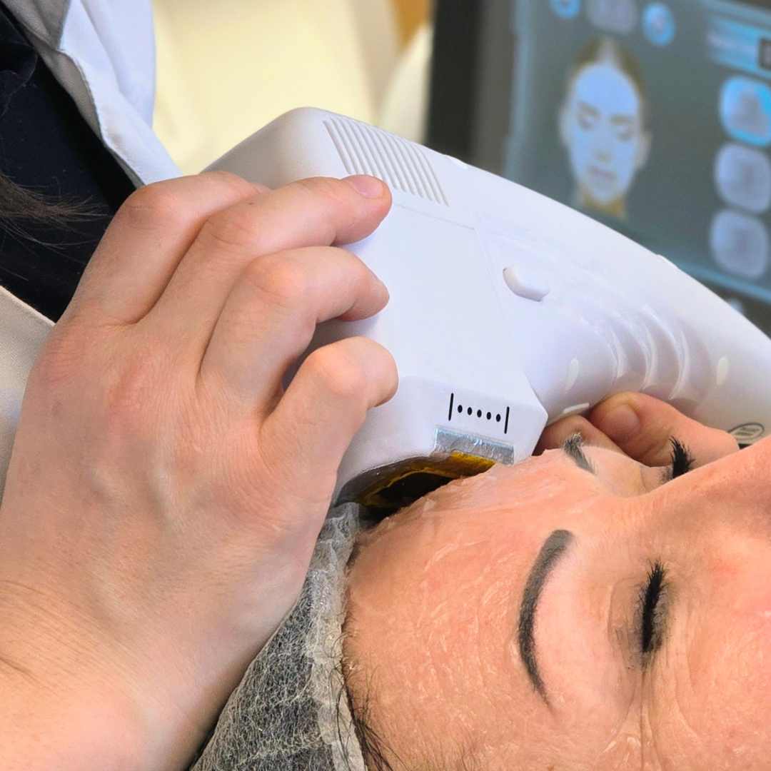 Hifu kezelés Érden (1) Hifu kezelés Érden