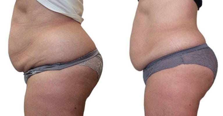 Kezdd el időben az alakformálást Érden: Itt találod a leghatékonyabb kezeléseket