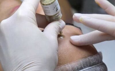 Az SQT kezelés: Természetes bőrfiatalítás Érden