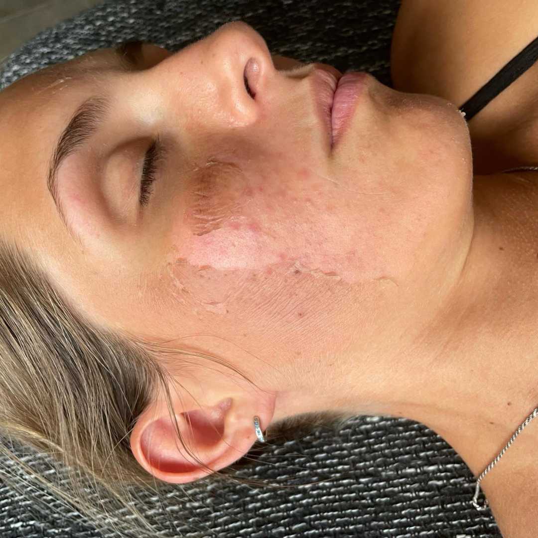 SQT biomikrotűs kezelés-Érd (2) SQT biomikrotűs kezelés