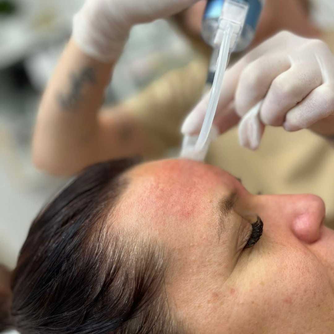 SkinBooster kezelés az Ebony Orvoskozmetikai szépségszalonban érden (2) SkinBooster kezelés az Ebony Orvoskozmetikai szépségszalonban érden1