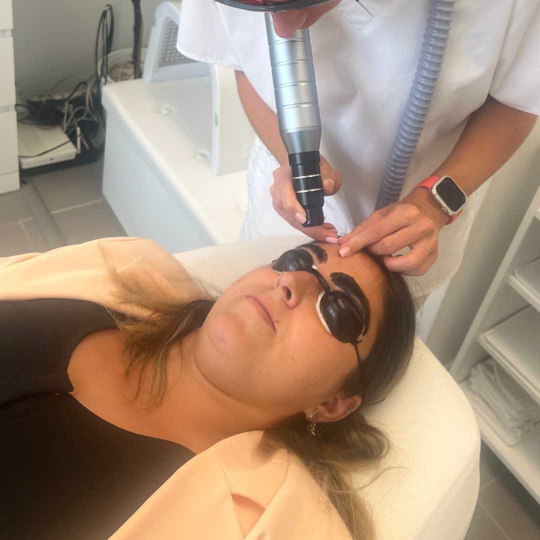 Tetoválás eltávolítás-Érd (1) Tetoválás eltávolítás-Érd