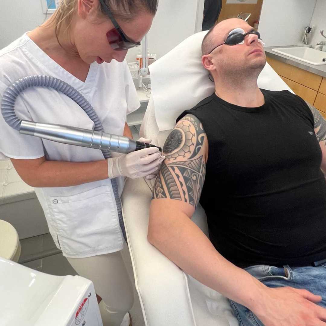 Tetoválás eltávolítás-Érd (2) Tetoválás eltávolítás-Érd