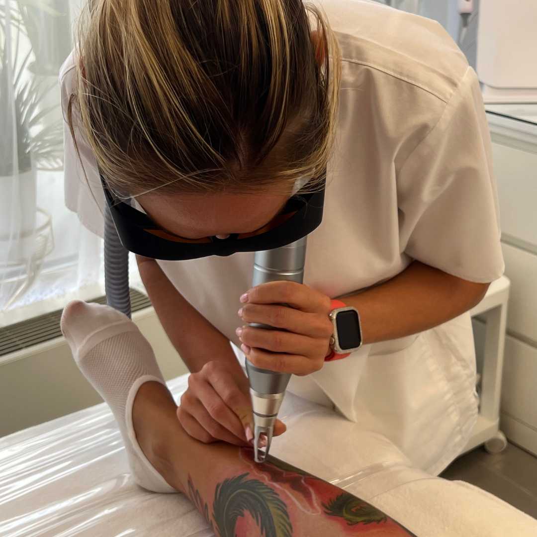 Tetoválás eltávolítás-Érd Tetoválás eltávolítás-Érd