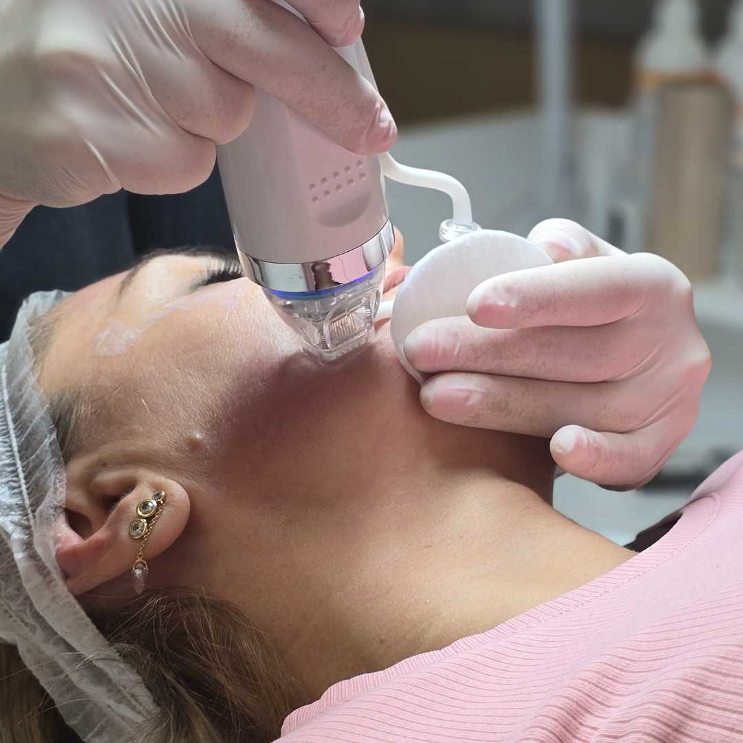 Tűs RF kezelés-Érd (1) Tűs RF kezelés-Érd