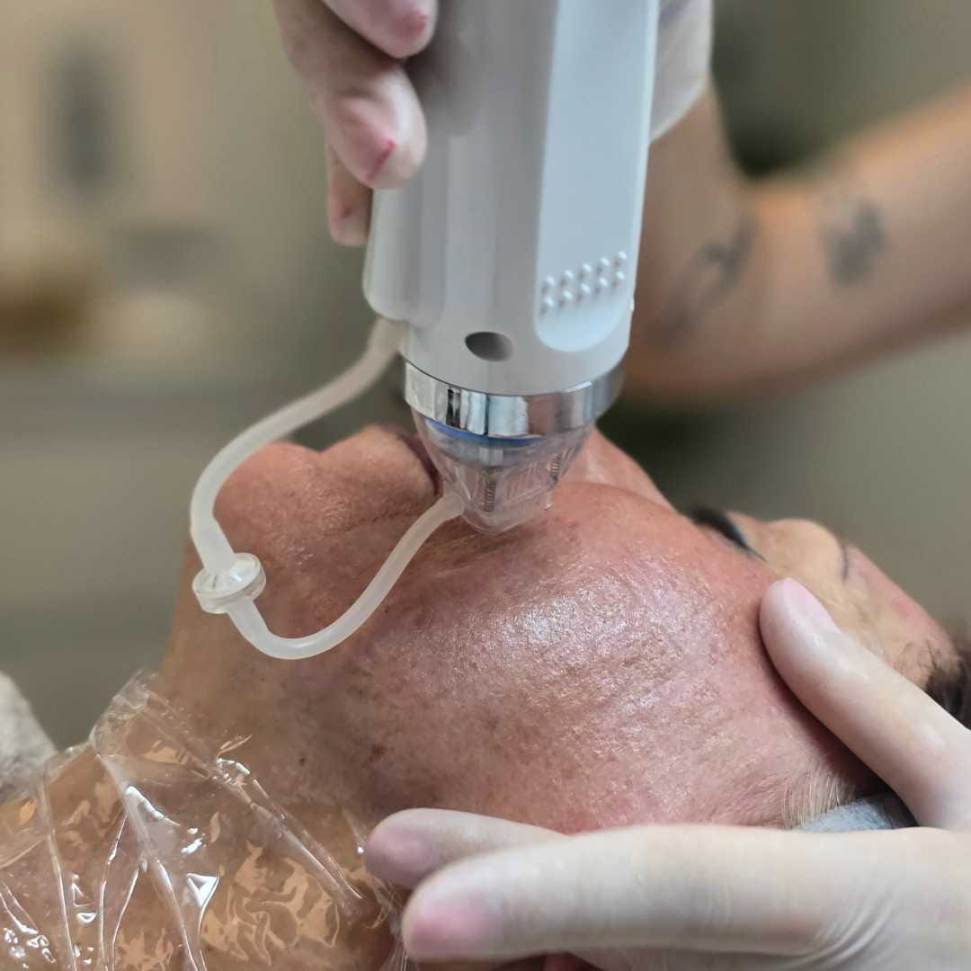 Tűs RF kezelés-Érd (2) Tűs RF kezelés-Érd (2)