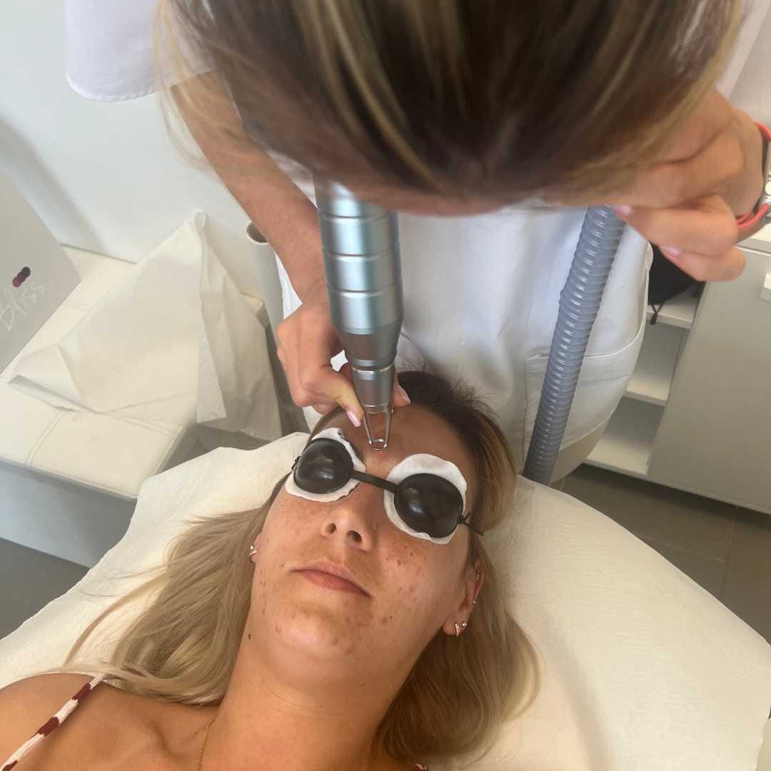 pigmentfoltok és májfoltok hatékony eltávolítása Érden pigmentfoltok és májfoltok hatékony eltávolítása Érden