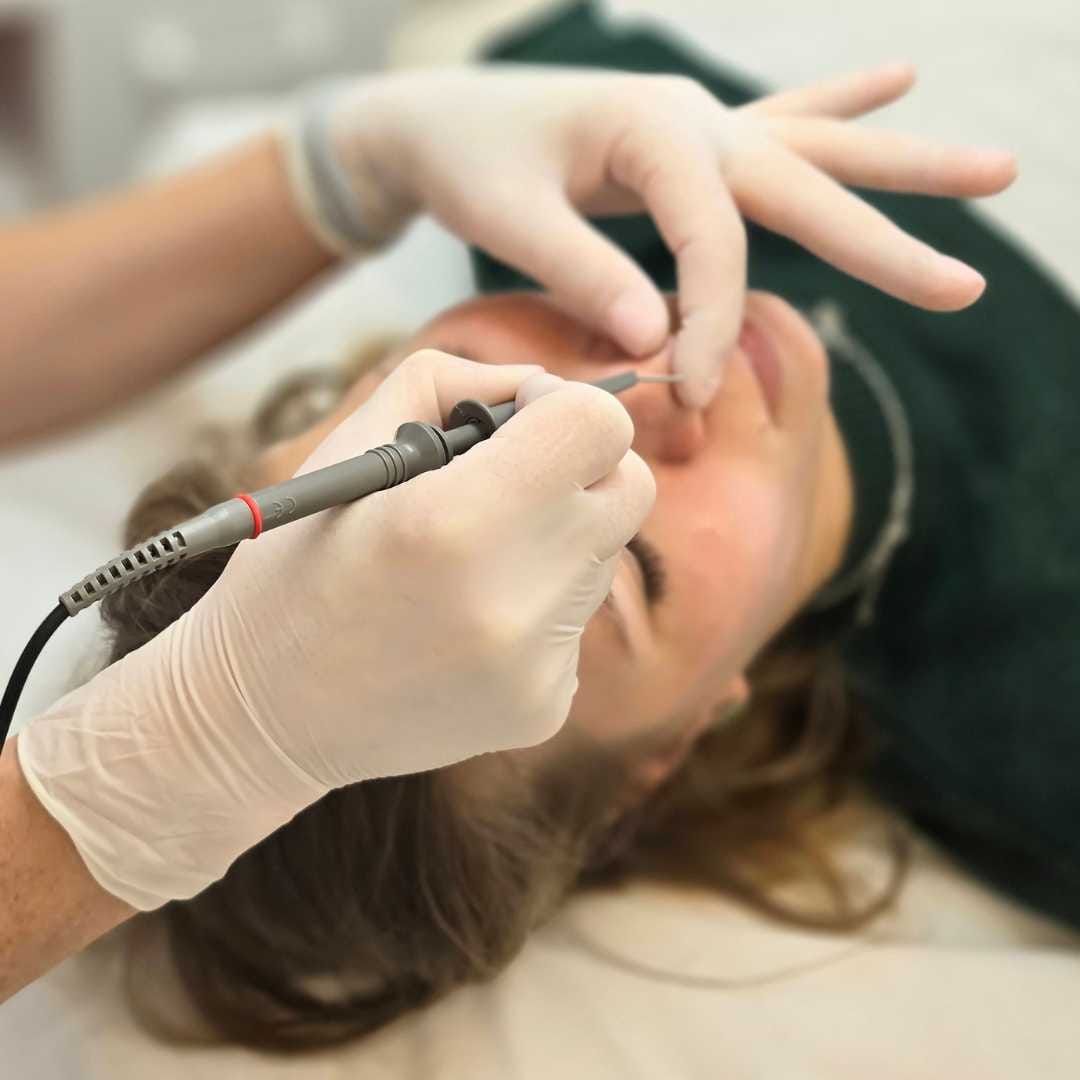 thermokoaguláció kezelés-Érd thermokoaguláció kezelés-Érd