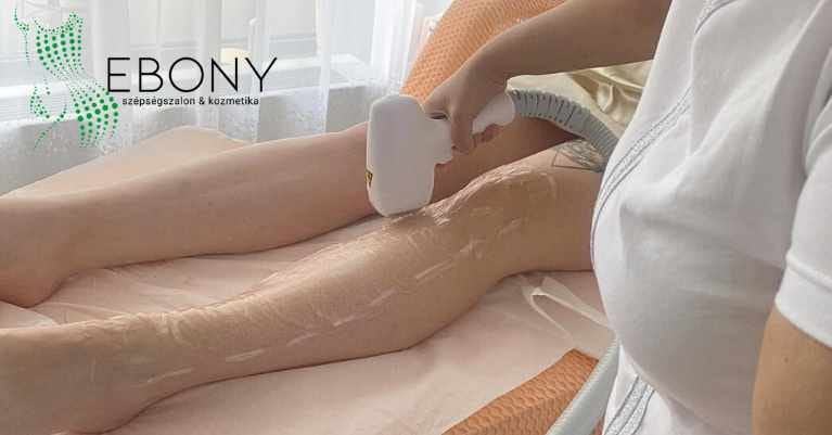 Lézeres szőrtelenítés Érden: Minden, amit tudnod kell a tartós szőrtelenítésről