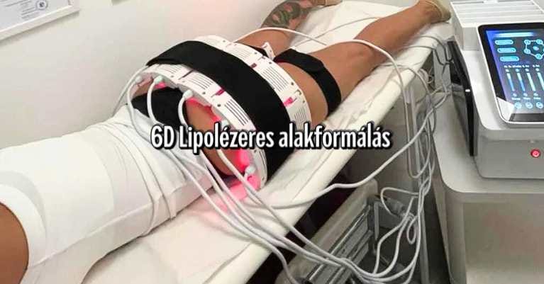 Hogyan működik a 6D Lipolézeres alakformálás Érden?
