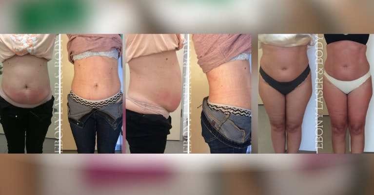 Alakformáló kezelések: A tartós eredmények valódi titka