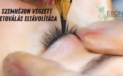 Szemhéjon végzett tetoválás eltávolítás – amit tudnod kell, mielőtt belevágsz