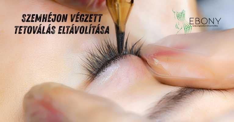 Szemhéjon végzett tetoválás eltávolítás – amit tudnod kell, mielőtt belevágsz