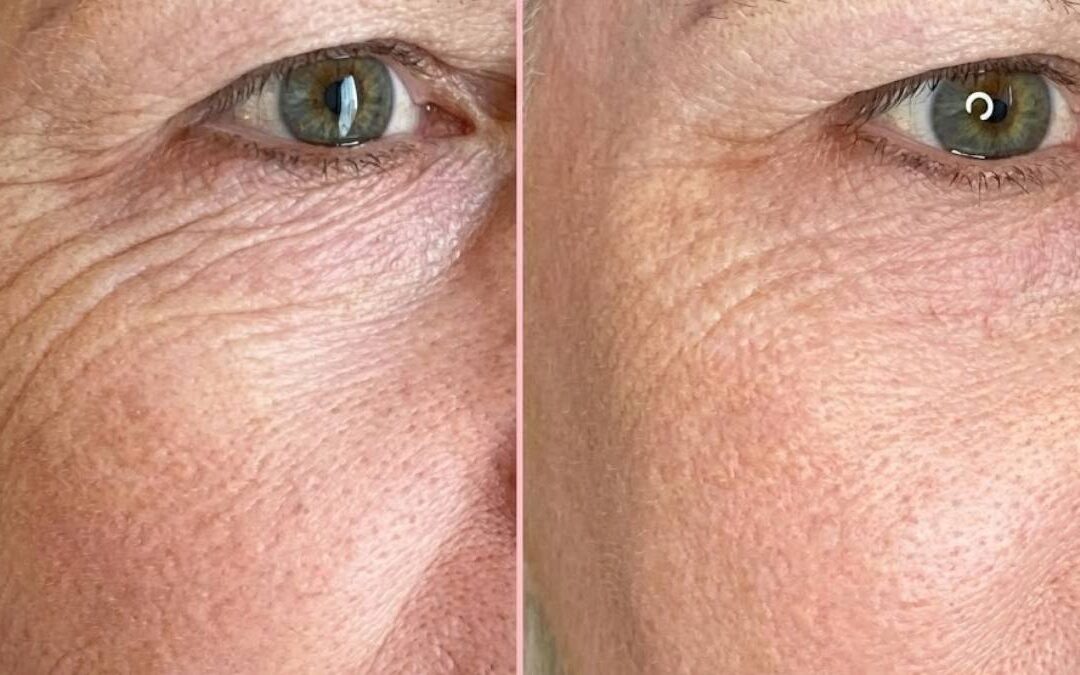 Termikus ionizációs kezelés Érden – látványos szemkörnyék-fiatalítás műtét nélkül